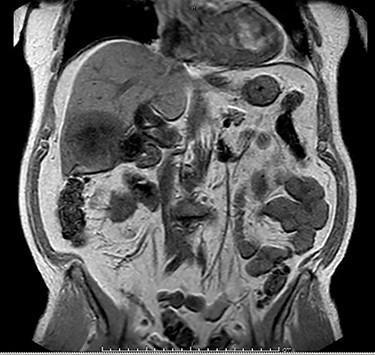 MRI (coronal view).
