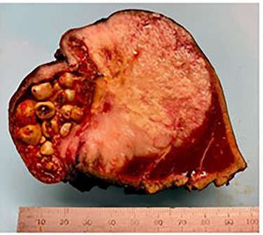 Gross cross section of the gallbladder demonstrating tumor involvement and cholelithiasis.