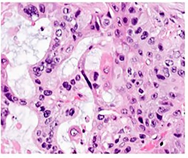H&E stain of the tumor demonstrating adenosquamous features.
