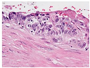 H&E stain demonstrating peritoneal surface involvement.