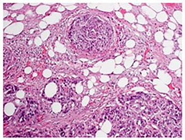 H&E stain demonstrating involvement of the lesser omentum.