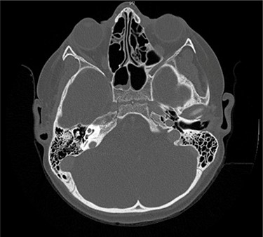 Axial CT taken 2 months after initial presentation demonstrates lucency of the right petrous apex representing partial pneumatization, as well as osseous erosion of the posterior cortex.