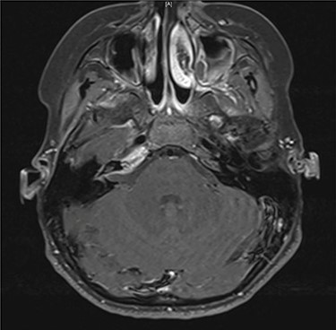 Axial contrast-enhanced T1-weighted image taken 3 months after admission shows enhancement within the right petrous apex and anterior aspect of the internal auditory canal.