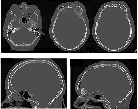 (A, B) Preoperative CT imaging showing extensive anterior and skull base fractures. The patient ultimately developed a cerebrospinal fluid leak and required operative repair. (C) Postoperative CT imaging showing bifrontal craniotomy repair as well as repair of the anterior skull base.
