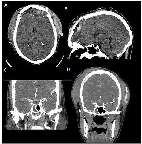 CT angiography taken at 2 weeks postoperatively when patient returned with sudden onset of facial swelling and significant headache. (A, B) Noncontrasted CT of the head showing significant subgaleal hematoma and adjacent bifrontal subdural hematoma with associated mass effect. (C) Prior trauma imaging (CT angiography of the neck) from initial hospitalization showing no evidence of STA pseudoaneurysm. (D) CT angiography showing a large (18 mm × 7 mm) left STA pseudoaneurysm (white arrow).
