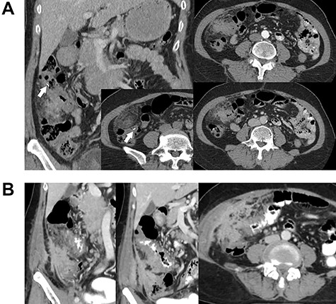 Contrast-enhanced abdominal CT. Images (A) and (B) were obtained 5 months apart. Image A shows irregular circumferential thickening of the colonic hepatic flexure. An elongated foreign body is also visible in the area (arrow). Image B shows an increase in the size and extension of the thickening. There is also a newly-detected heterogenous enhancing mass-like lesion involving the lateral wall of the cecum and proximal ascending colon, with enhancement indicating irregular thickening of the adjacent peritoneum.