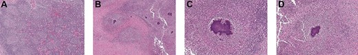Histological images of the resected mass demonstrating multiple abscesses, necrosis and typical ‘sulfur granules’ in actinomycosis bacterial colonies.