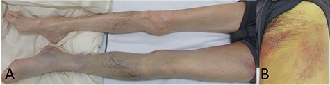(A) Picture of the lower extremities of the patient. His left limb was edematous and hemostatic. (B) Picture of the left thigh. The patient’s thigh appeared reddish and had pain.