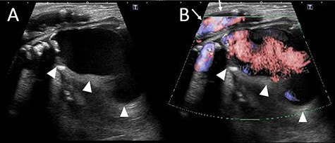 (A) The ultrasound image. The deltas point the PFAA. (B) Color Doppler imaging using ultrasonography. The deltas indicate the PFAA, and the arrows indicate the blood flow of the SFA.