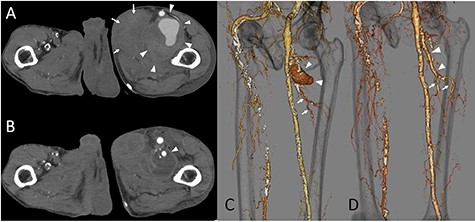 (A) The CT scan image. The deltas indicate the PFAA, which was 64 × 54 mm. The arrows indicate the hematoma inside the adductors. (B) Postoperative CT image. The delta point interposed the PFA. The hematoma inside the adductors decreased. (C) The 3-dimension image obtained by the CT scan. The deltas indicate the PFAA. The arrows indicate the terminal branches toward the muscles. (D) The 3-dimension image obtained by postoperative CT. The deltas point to the artificial graft. The arrows indicate the preserved branches from the PFA toward the muscles.