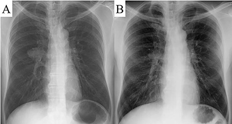 A round mass was detected in the hilum of the right lung by chest radiography (A). A chest radiograph taken one and a half years previously displayed a normal view (B).