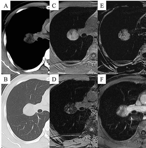 Chest CT images displaying the mass lesion; the low-attenuated mass was displayed in the mediastinal window (A), and the diameter of the mass was 3.5 cm and the mass was located close to the fissure of the right lung in the pulmonary window (B). Chest MRI displaying the mass lesion; the mass lesion was displayed as a high signal on in-phase T1WI (C), the mass was displayed as a low signal on out-of-phase T1WI (D), the mass was displayed as a low signal on T2WI (E), and the mass lesion was not clearly enhanced by fat-saturated contrast-enhanced T1WI with extracellular gadolinium contrast material (gadoterate meglumine; Magnescope®; Guerbet) (F).