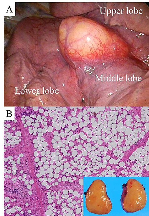 View during VATS (A). Hematoxylin and eosin staining of a section of the resected tumor (high magnification). The inset is a macroscopic photograph of the cut surface of the tumor (B).