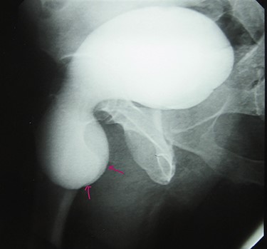 Retrograde urethrocystography: right inguinal hernia containing a portion of the urinary bladder.
