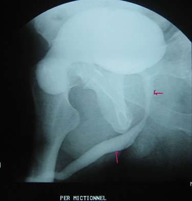 Urethrocystography: no obstruction under the bladder in the per mictional image.