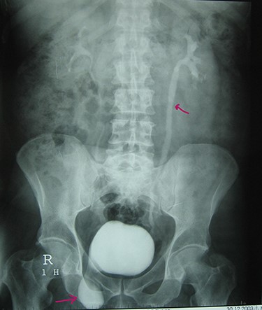 Intravenous urography: moderate left hydronephrosis and bladder addition image.