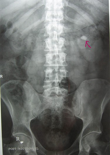 Intravenous urography: nonobstructive pyelic calculus of 1.5 cm.