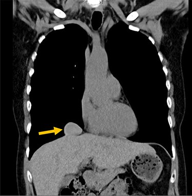 Larger lung nodule measuring 1.5 cm × 2.8 cm on CT scan.