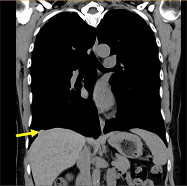 Smaller nodule measuring 0.9 cm × 1.5 cm on CT scan.