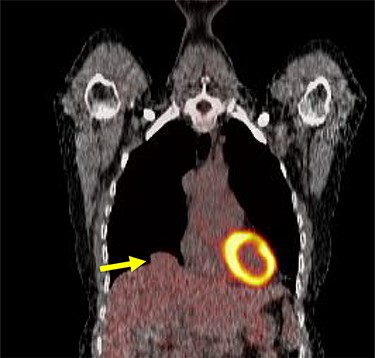 Larger nodule on PET scan