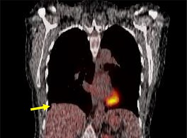 Smaller nodule on PET scan.
