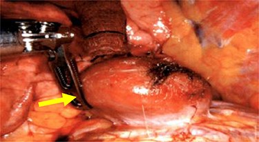 Liver herniation corresponding to the location of larger lung nodule seen on CT scan.