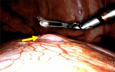 Liver herniation corresponding to the location of smaller lung nodule seen on CT scan.