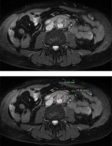 MRCP demonstrating an abdominal aortic saccular aneurysm measuring ~18 × 16mm with associated periaortic soft tissue enhancement suggestive of a mycotic aneurysm. The study was negative for signs of cholangitis.
