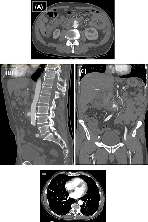CTA performed following the MRCP demonstrating the presence of a thick-walled multi-lobulated saccular aneurysm arising from the anterior wall of the infrarenal abdominal aorta approximately at the level of the IMA origin. The aneurysm measures ~35 × 23 × 32 mm with adjacent soft tissue stranding and enlarged nodes in the aortocaval and left para-aortic region (A–C). The incidentally noted right middle lobe nodule is also demonstrated (D; white arrow).
