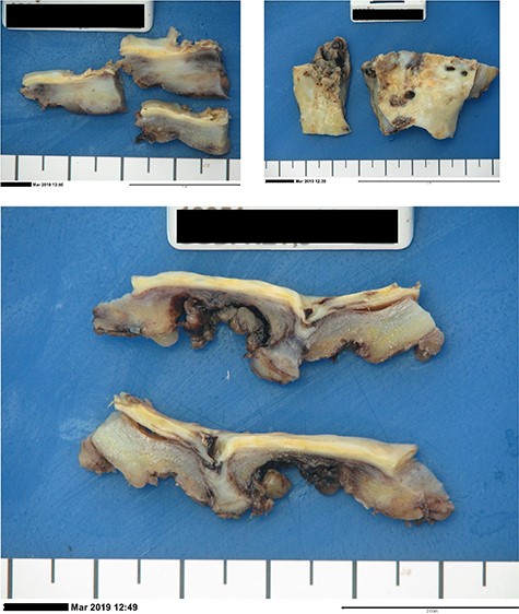 Post-operative laboratory photographs of the resected infra-renal aorta sent for tissue microscopy, culture and sensitivity, as well as histopathological review.