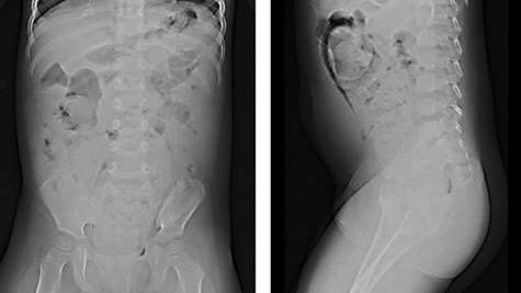 Abdominal X-ray: abdominal X-ray showed a stored stool mass.