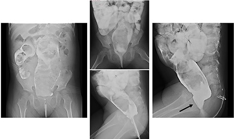 Barium enema: barium enema revealed dilatation from the rectum to the sigmoid colon due to a stool mass and the rectum showed a smooth funnel-shaped tapering toward the anus when she forced herself to defecate (black arrow: funnel-shaped tapering).
