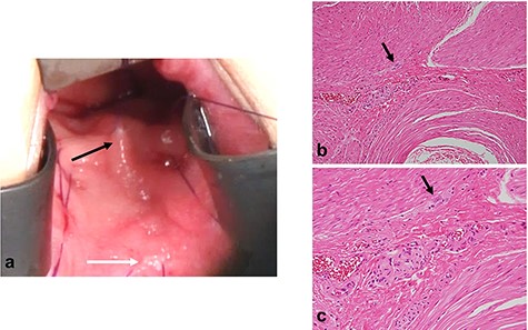 Surgical rectal full-thickness biopsy. (a) Surgical rectal full-thickness biopsy was performed 2 cm proximal to the dentate line under general anesthesia. (b, c) Pathologic findings revealed few ganglion cells in Auerbach’s plexus (b: low-power field, c: high-power field, black arrow; ganglionic cells).
