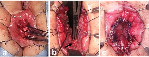 Soave endorectal pull-through with an oblique anastomosis. (a) The site of mucosectomy in the rectum was located posteriorly 0.5 cm from the dentate line, laterally 1.0 cm from the dentate line, and anteriorly 1.5 cm above this point. (b) The posterior wall of the aganglionic anorectum was split longitudinally to the level of the dentate line. (c) The oblique anastomosis between the pulled-through bowel and the rectum was performed posteriorly 0.5 cm from the dentate line, laterally 1.0 cm from the dentate line and anteriorly 1.5 cm above this point.