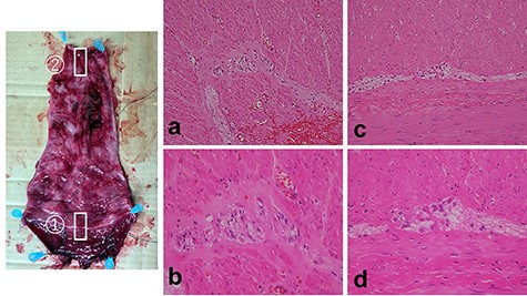 Resected specimen and pathologic findings. Resected specimen (①: anal side; ②: anal side). (a, b) In Auerbach’s plexus of the mucosectomy in the rectum, few ganglion cells with scanty cytoplasm were visualized (a: low-power field, b: high-power field). (c, d) In Auerbach’s plexus of the sigmoid colon, most of the ganglion cells had scanty cytoplasm, whereas few ganglion cells with large cytoplasm were visualized.