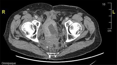 CT image showing an extensive mass in the presacral region with invasion to the urinary bladder and both ureters.