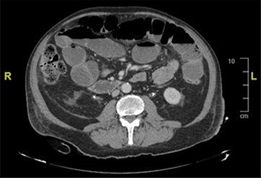CT image showing distended bowel loops indicating bowel obstruction caused by the pelvic mass.