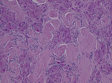 PAS stain showing PAS granular cytoplasm, magnification × 4.