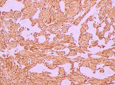 S-100 stain positive, magnification × 4.