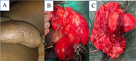 (A) Huge right scrotal mass, (B) intraoperative image of scrotal mass and (C) excised scrotal mass weighing 1100 g.