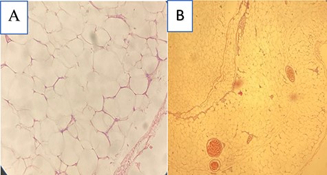 Microscopic section of scrotal mass (A) ×40 lobules of matured lipocytes with a fibrous capsule and (B) ×40 matured lipocytes with few blood vessels.
