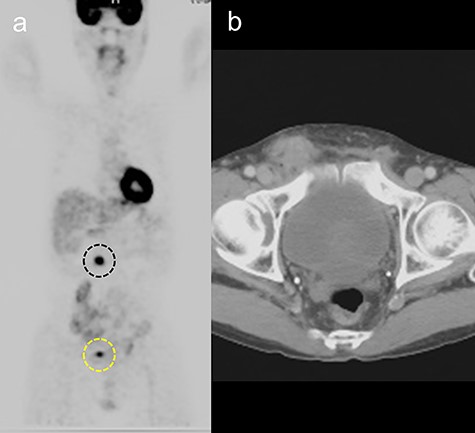 (a) Fluorine-18 fluorodeoxyglucose positron emission tomographic scan showing positive findings in the transverse colon (black dotted line) and right inguinal area (yellow dotted line). (b) Computed tomography scan showing a mass with indistinct margins in the right inguinal area, 5 years after hernia repair.