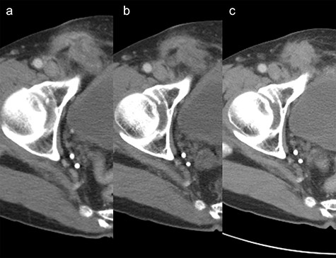 Change over time after transverse colon resection in the right inguinal area on computed tomography scan. (a) 7 years year after hernia repair. (b) 8 years after hernia repair. (c) nine and a half years after hernia repair.
