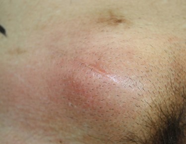 Physical findings included redness and swelling along the surgical scar.