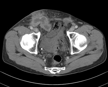 Computed tomography scan revealed abscess formation with contrast effect in the right inguinal area.