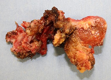Resected mesh covered with granulation tissue.