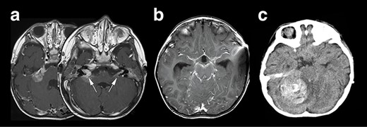 Neuroradiological representation of the lesions, T1WI showed a homogeneously enhanced lesion at the cerebellopontine angle spreading to the bilateral auditory canal (white arrows) (a), and a widespread leptomeningeal enhancement was encasing the brainstem (b). Unfortunately, the patient’s condition suddenly deteriorated, and the CT image revealed a massive intra-tumoral hemorrhage compressing the brainstem (c).