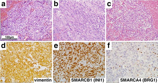 Histological and immunohistochemical findings (×400). Hematoxylin and eosin staining revealed a tumor comprising epithelioid (a), spindle cells (b) and rhabdoid cells (c). In addition, immunohistochemistry showed diffuse positivity for vimentin (d) and SMARCB1 (INI1) (e), but loss of SMARCA4 (BRG1) (f) expression.