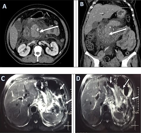 Pre-operative CECT abdomen pelvis (a, b) and MRCP (c, d) showing pancreatic necrosis and spread of inflammation around the pancreas as shown by red arrows.