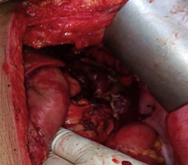 Necrotic pancreatic tissue in the lesser sac undergone necrosectomy.